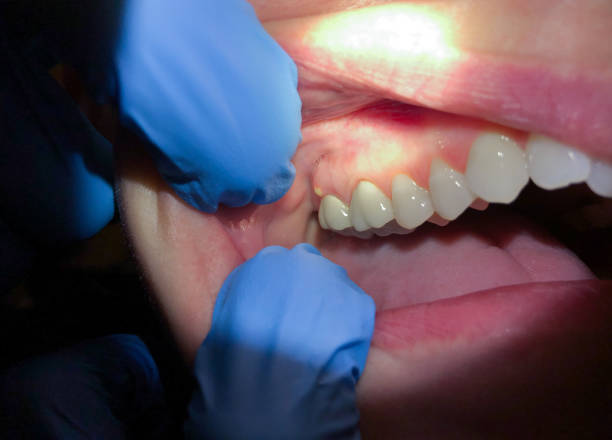 Best Emergency Root Canal Treatment in Estherville, IA